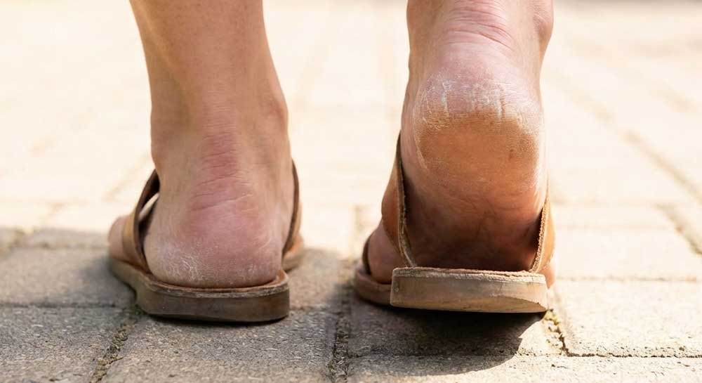 맨발 노출 부끄러움