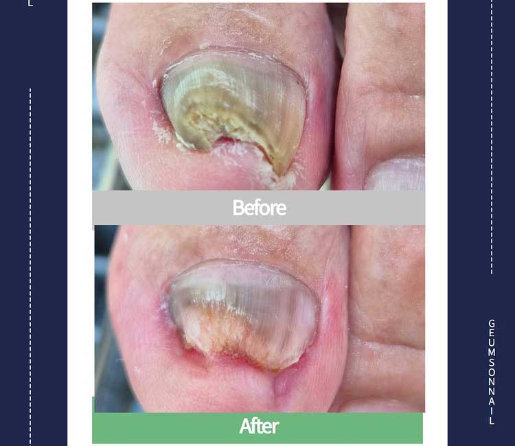 관리 전 발 상태