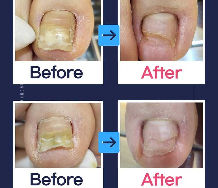 관리 전 발 상태